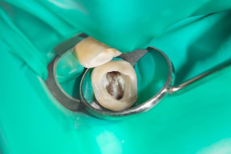 czym jest endodoncja