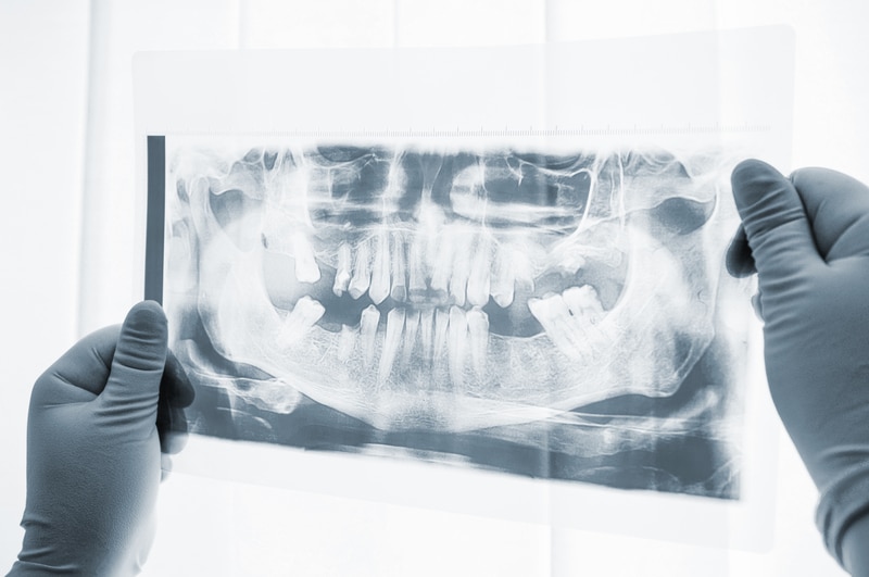 leczenie chirurgiczne zębów w klinice Implantis