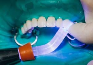 licówki na zęby Implantis Kraków