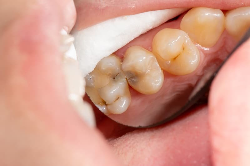 usuwanie ósemek klinika implantis