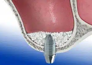 zabieg sinus lift